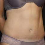 Tummy Tuck Before & After Patient #22489