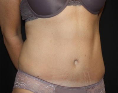 Tummy Tuck Before & After Patient #22489