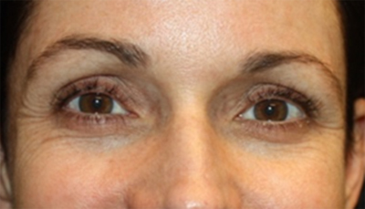 Botox and Dysport Before & After Patient #20069