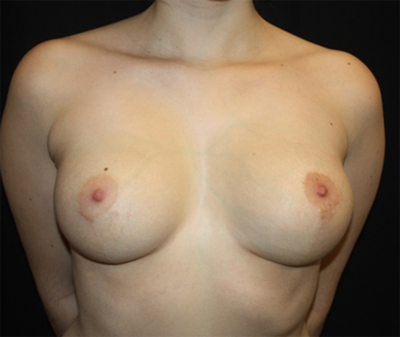 Breast Reduction Before & After Patient #21019