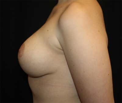 Breast Reduction Before & After Patient #21019