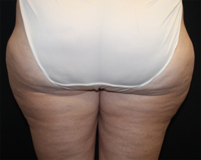 Liposuction Before & After Patient #21426