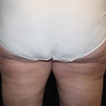 Liposuction Before & After Patient #21426