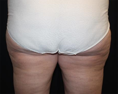 Liposuction Before & After Patient #21426