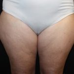 Liposuction Before & After Patient #21426