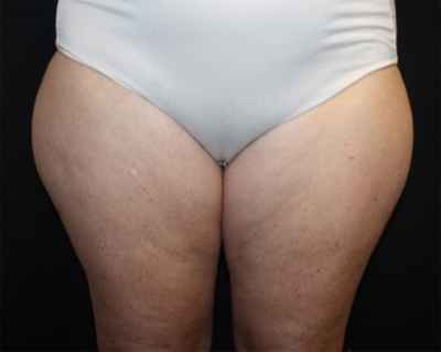 Liposuction Before & After Patient #21426