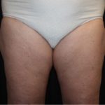 Liposuction Before & After Patient #21426