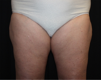Liposuction Before & After Patient #21426