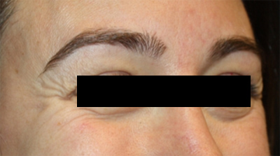 Botox and Dysport Before & After Patient #20082