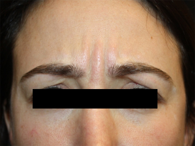 Botox and Dysport Before & After Patient #20082