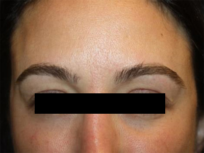 Botox and Dysport Before & After Patient #20082