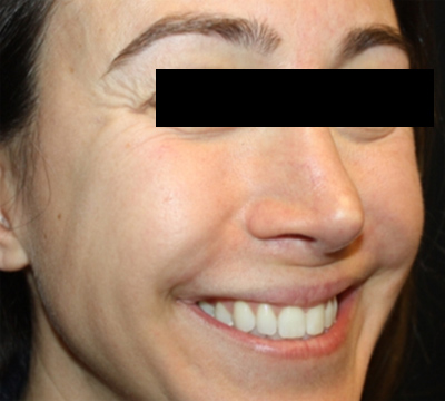 Injectable Fillers Before & After Patient #21342