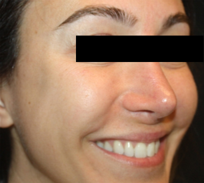 Injectable Fillers Before & After Patient #21342