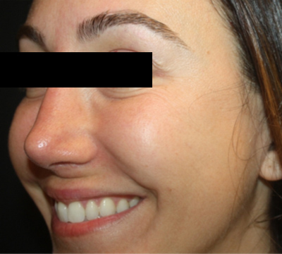 Injectable Fillers Before & After Patient #21342