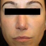 Injectable Fillers Before & After Patient #21342