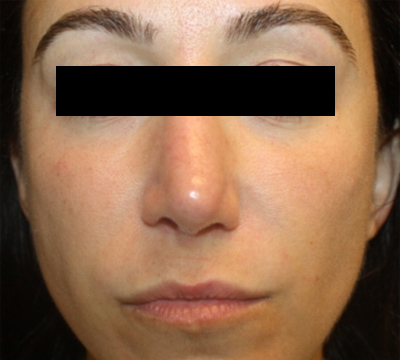Injectable Fillers Before & After Patient #21342
