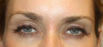 Botox and Dysport Before & After Patient #20052