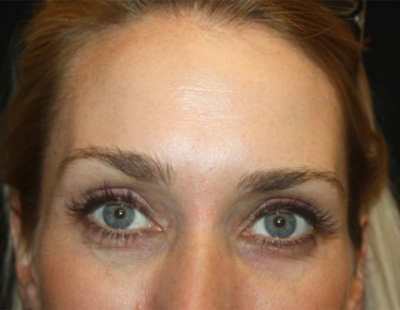 Botox and Dysport Before & After Patient #20052