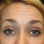 Botox and Dysport Before & After Patient #20052