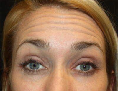 Botox and Dysport Before & After Patient #20052