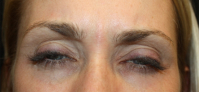 Botox and Dysport Before & After Patient #20052