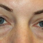 Blepharoplasty Before & After Patient #20176