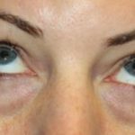 Blepharoplasty Before & After Patient #20176