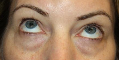 Blepharoplasty Before & After Patient #20176