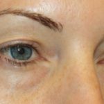 Blepharoplasty Before & After Patient #20176