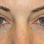 Blepharoplasty Before & After Patient #20176