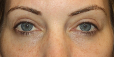 Blepharoplasty Before & After Patient #20176