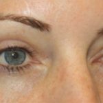 Blepharoplasty Before & After Patient #20176