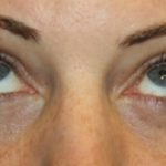 Blepharoplasty Before & After Patient #20176