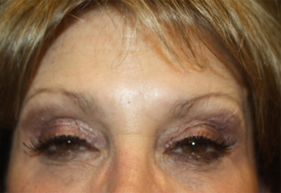 Botox and Dysport Before & After Patient #20087