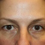 Blepharoplasty and Brow Lift Before & After Patient #20262