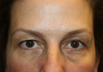Blepharoplasty and Brow Lift Before & After Patient #20262