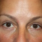 Blepharoplasty and Brow Lift Before & After Patient #20262