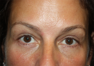 Blepharoplasty and Brow Lift Before & After Patient #20262