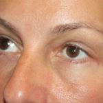 Blepharoplasty and Brow Lift Before & After Patient #20262