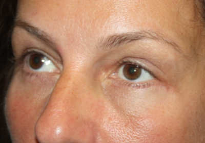 Blepharoplasty and Brow Lift Before & After Patient #20262