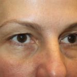 Blepharoplasty and Brow Lift Before & After Patient #20262