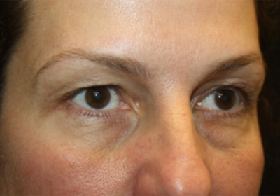 Blepharoplasty and Brow Lift Before & After Patient #20262