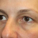 Blepharoplasty and Brow Lift Before & After Patient #20262