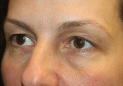 Blepharoplasty and Brow Lift Before & After Patient #20262