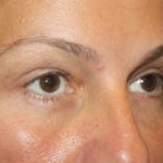 Blepharoplasty and Brow Lift Before & After Patient #20262