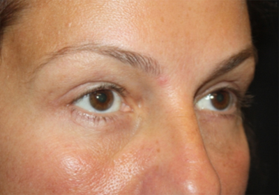 Blepharoplasty and Brow Lift Before & After Patient #20262