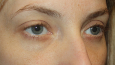Blepharoplasty Before & After Patient #20189