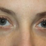Blepharoplasty Before & After Patient #20189