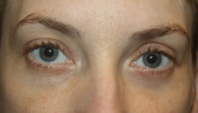 Blepharoplasty Before & After Patient #20189