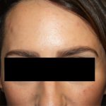 Botox and Dysport Before & After Patient #20108